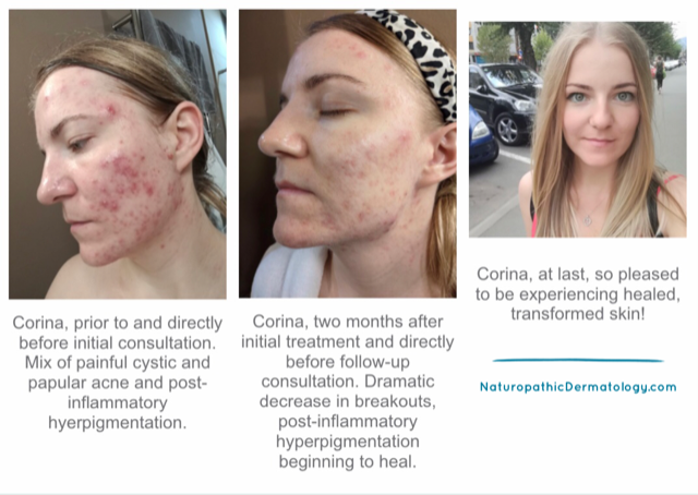 AcnaPrev Nutrient Complex by Naturopathic Dermatology